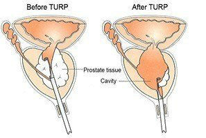 Minimally Invasive Prostate Surgery Benign Prostatic Hyperplasia Bph Melbourne